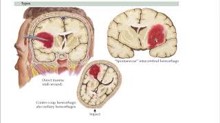 Intracerebral Hemorrhage Hemorrhagic Stroke [upl. by Dnomde954]