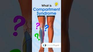 Compartment Syndrome anatomy physicaltherapy physiotherapy compartmentsyndrome [upl. by Rosenfeld]