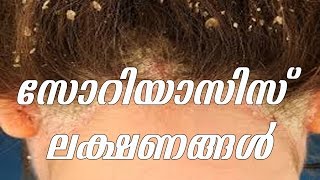 സോറിയാസിസ് ലക്ഷണങ്ങൾ  symptoms of psoriasis  Dr K V Shoyson  Arogyavicharam  TV Live Asia [upl. by Jepum]