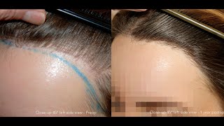 FUE Correction on 25YearOld Woman – Dr Feriduni Fixes Failed Hair Transplant [upl. by Atinwahs]