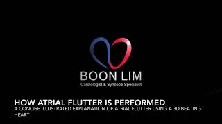 Atrial Flutter Ablation  A concise illustrated video explaining how atrial flutter is performed [upl. by Nadabb]