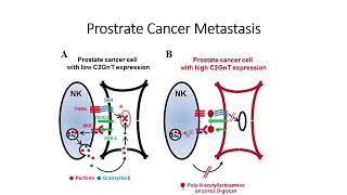 Prostrate Cancer Metastasis Code 581 [upl. by Christin]