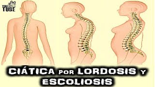 CIATICA DOLOR LORDOSIS Y ESCOLIOSIS TRATAMIENTO LA VERDAD [upl. by Apurk]