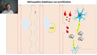 26retinopathie diabetique 2 [upl. by Acnaiv]