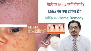 Milia Treatment  Whiteheads  Milia का इलाज  milia treatment at home  milia removal cream milia [upl. by Alvina]