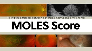 Telling the difference between a choroidal naevus and a melanoma The MOLES Score  OT Skills Guide [upl. by Dett995]