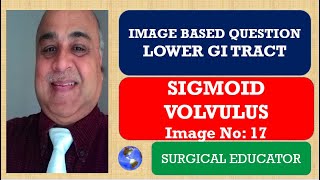 SIGMOID VOLVULUS  LOWER GI TRACT Image Based Question [upl. by Lorette815]