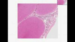 Histopathology Brain Acute pyogenic bacterial meningitis [upl. by Eak]