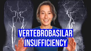 Vertebrobasilar Insufficiency VBI Test [upl. by Nauqal]