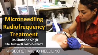 Microneedling RadiofrequencyRF Treatment  Secret RF  Nitai Cosmetics  Melbourne [upl. by Rezal881]