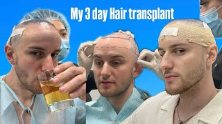 I got a hair transplant [upl. by Anikas]