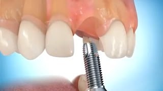 Implantátum videó  MindentMent® Fogászat [upl. by Erodoeht329]