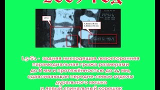 Грыжа позвоночника 14 мм 5 лет тренировок Результаты [upl. by Cianca]