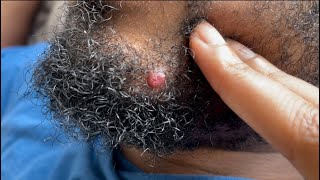 Enlarged Bump on beard ingrown hairs [upl. by Alimac]