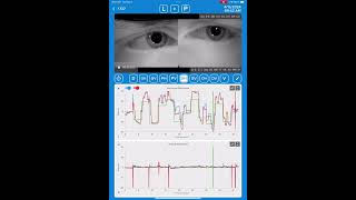 Pre and Post Eye Movement Testing Review [upl. by Ayidah416]