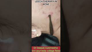 LEECH THERAPY IN ACNEAyurvedagyanseries [upl. by Aznola706]