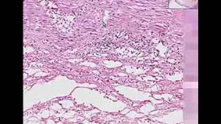 Histopathology ColonIschemic enterocolitis [upl. by Rania]