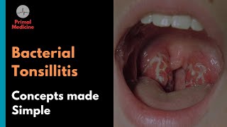 Bacterial Tonsillitis Centor Criteria and FeverPAIN Score [upl. by Sidalg]