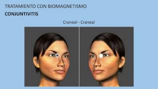 Conjuntivitis Tratamiento con biomagnetismo 9 [upl. by Ossy954]