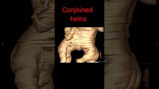 Conjoined Twins shorts shortvideo radiology trending ConjoinedTwinsRadiology [upl. by Yenwat]