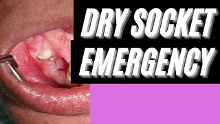 How to treat a Dry Socket drysocket [upl. by Mariandi418]