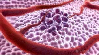 3D Medical Animation  What is Cancer [upl. by Ellehcear254]