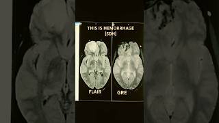 MRI BRAIN HEMORRHAGE education medicalimaging radiology [upl. by Idnahk]