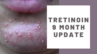 TRETINOIN CREAM 9 MONTH UPDATE  Whiteheads purging and giving up tretinoin tretinoinpurge [upl. by Noinatrad]