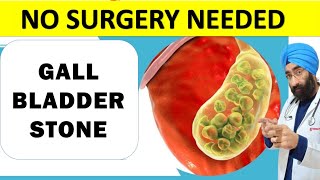 No Pain No Surgery Needed  Asymptomatic Gall Bladder Stone Treatment  DrEducation [upl. by Nehgem]