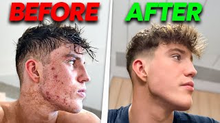 How I Cleared My Acne [upl. by Animrac]