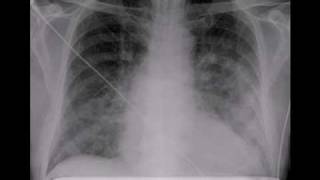 Chest xray Pulmonary edema lungs [upl. by Oly607]