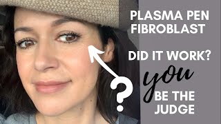 Fibroblast Plasma Pen  Does It Work YOU decide My 3 Month Before amp After Pics amp Videos [upl. by Ahtebbat]