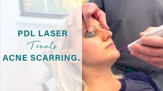 PDL Laser treats acne scarring  Board Certified Facial Plastic Surgeon [upl. by Ruelle520]