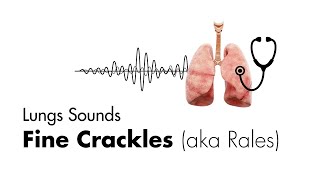 Fine Crackles Rales  Lung Sounds  MEDZCOOL [upl. by Luttrell]