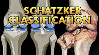 Schatzker Classification of Tibial Plateau Fractures [upl. by Aneekahs]