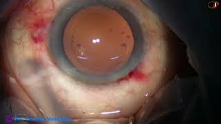 Prechopping is the way to go in Soft Cataracts  slow motion at the end of this video  P Mohanta [upl. by Robins]