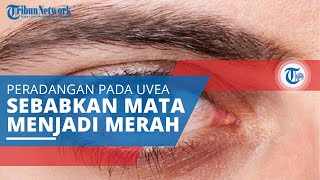 Uveitis Peradangan pada Uvea atau Lapisan Tengah Mata Ditandai Satu atau Kedua Mata Terlihat Merah [upl. by Benildis]