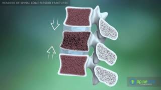 Spinal Compression Fracture Reasons [upl. by Elysee]