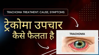 quotTrachoma Treatment Cause Symptoms  IN HINDI ट्रेकोमा उपचारकैसे फैलता है” [upl. by Anerec]