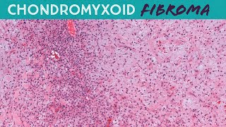 Chondromyxoid Fibroma CMF  Bone Pathology Basics Yale case 8 [upl. by Sillert497]