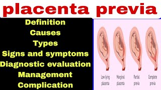 placenta previa [upl. by Yrrak]