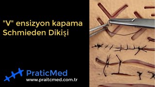 quotVquot ensizyon Kapama ve Schmieden Dikişi I PraticMed® Sütür Eğitim Videoları [upl. by Mikel]