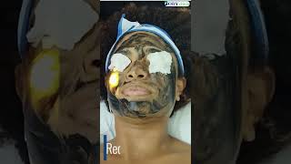 Revitalize Your Skin with Carbon Laser Peel at BodyClinix  Advanced Skin Treatment [upl. by Tam670]