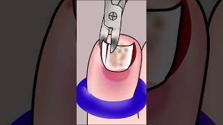 ASMR Ingrown Toenail Removal Treatment P3 asmr animation satisfying viral trending shorts [upl. by Rabelais]