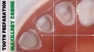 Tooth Preparation 🔵 Maxillary Canine 🟡 PFM [upl. by Rozelle]