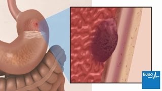 How a peptic ulcer develops  Bupa Health [upl. by Mcginnis144]