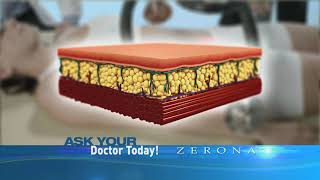 Erchonias Zerona Z6 Fat Loss Laser  Science Behind the Laser [upl. by Novaat]