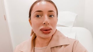 I GOT MY BOTCHED LIP FILLER DISSOLVED AFTER 3 YEARS OMG [upl. by Davison]