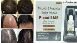 Fixodil M5 Hair Solution ALCOHOL FREE Minoxidil amp FinasterideTopical Solution [upl. by Julia883]