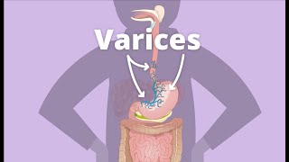 Cirrhosis – Varices [upl. by Annerahs144]